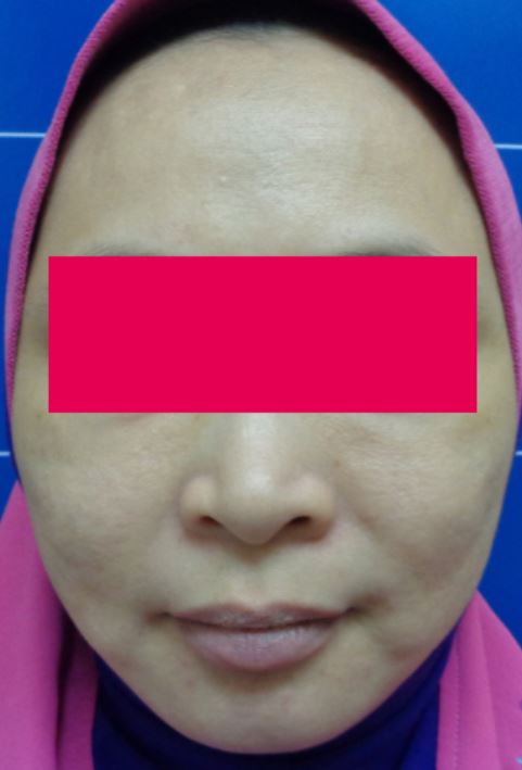 After-Female, 44, HIFU For Face