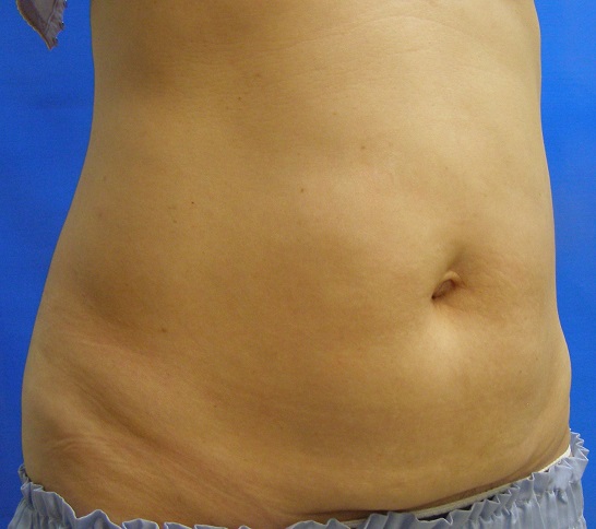 After-Female, 58, HIFU Treatment For Body