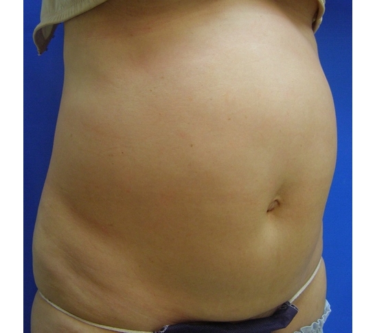 Before-Female, 58, HIFU Treatment For Body