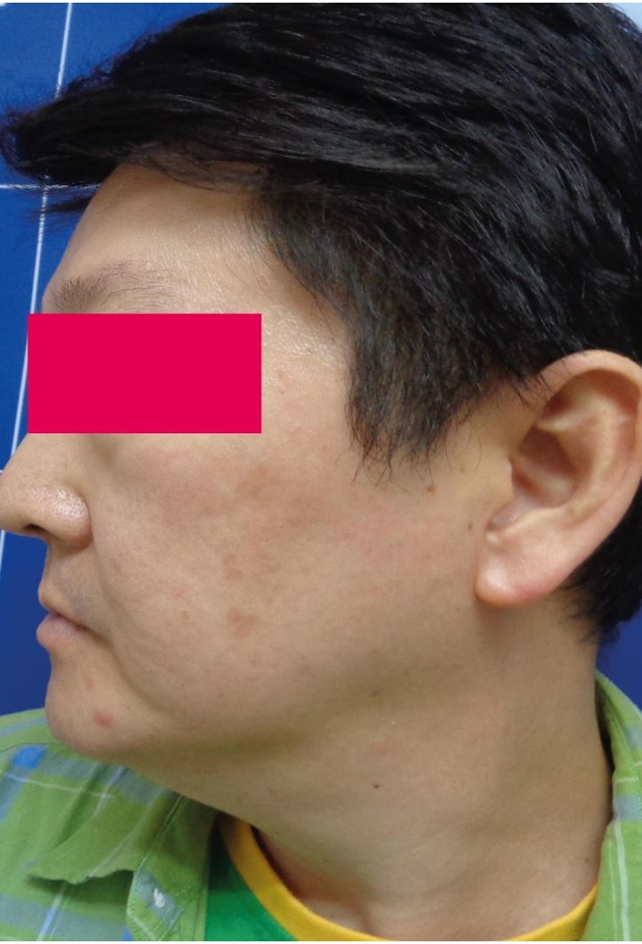 After-Male, 62, Laser For Pigmentation