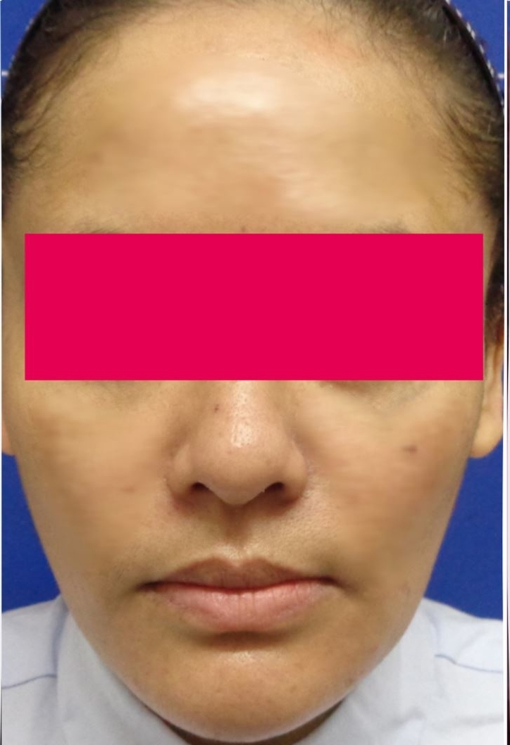 After-Serdev Suture Threadlift