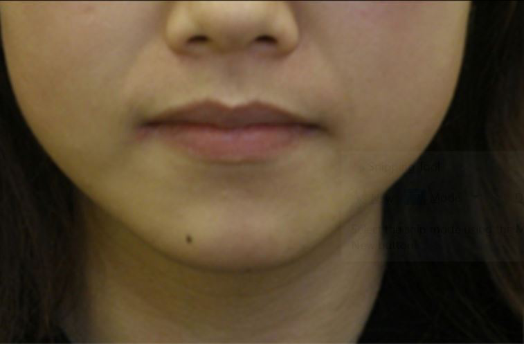 Before-Female, 32, Dermal Filler