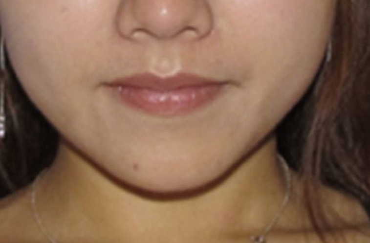 After-Female, 32, Dermal Filler