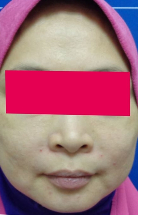 Before-Female, 44, HIFU For Face